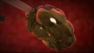 The air sacs in the lungs being filled with secretions, which results in the final cause of the extremely agonizing deaths of Somad and Siraki, which of course is eventual asphyxiation/suffocation by bacterial pneumonia