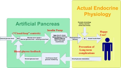 Artificial Pancreas