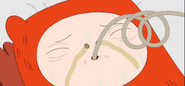 Finn gets infected by the rat bite.