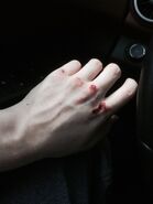 Bloody-knuckles