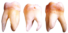 Three pieces of loose teeth.