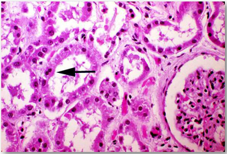 Lesão renal