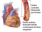 Infarto-coracao(1)