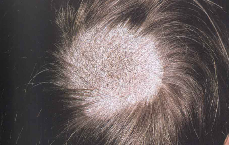 Micose do couro cabeludo em crianças (tinea capitis): Qual é o