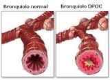 Bronquiolo com