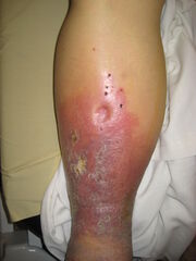 Pitting Edema2008