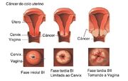 Câncer-colo-uterino