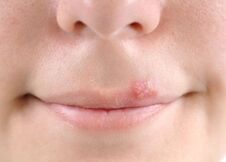 Lesao herpes