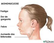 Mononucleose-788542