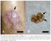 Cromoblastomicose