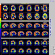 Cintilocerebral2