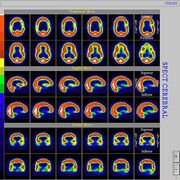 Cintilocerebral2