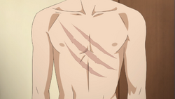 Sakuta's scars, received from Adolescence Syndrome.