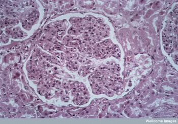 Glomerulonefrite.jpg.jpg