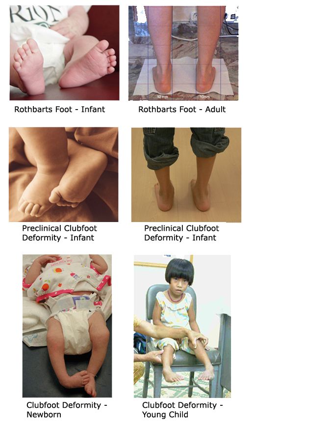 3 Embryological Foot Types Athlepedia The Athletics Wiki Fandom