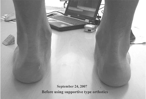 arch supports for feet