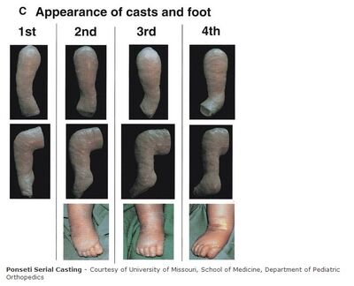 Ponseti Casting Technique