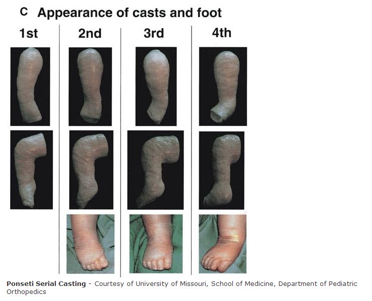 Preclinical Clubfoot Deformity Vs Clubfoot Deformity Athlepedia The Athletics Wiki Fandom