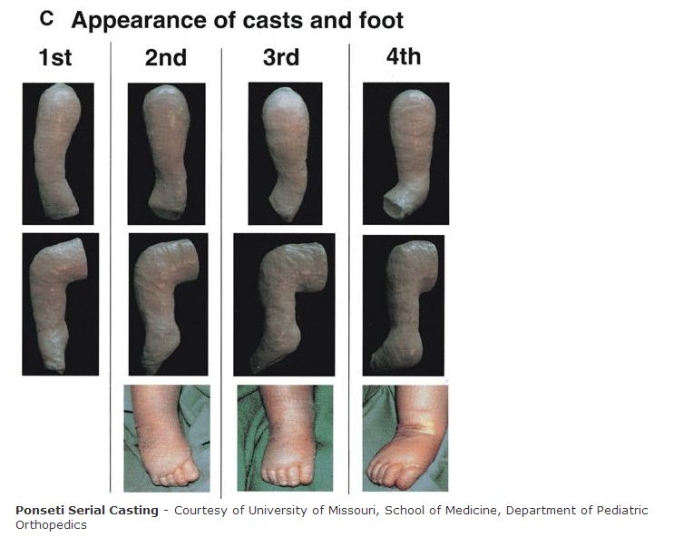 User Blog Professorrothbart Preclinical Clubfoot Deformity Vs Clubfoot Deformity Athlepedia The Athletics Wiki Fandom