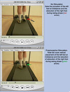 Treadmill Analysis - Case 3 demonstrating improvement using ProStims in RFS