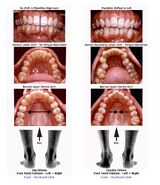 Dentition impacted by foot motion Photos