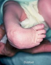 Clubfoot