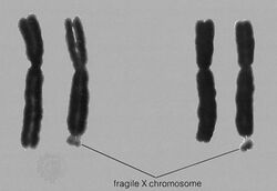 Fragile X Syndrome from Encyclopedia Britannica