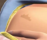 Annelieses Geburtsmal