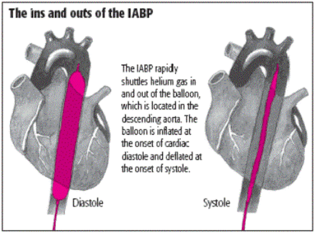 Aortic on sale balloon pump