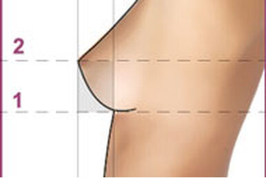 A breast cancer patient was estimated their bust and underbust