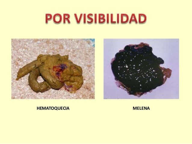 Melena y hemorragia digestiva: Como se dice heces con sangre en