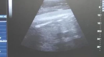 Kamea ultrasound1
