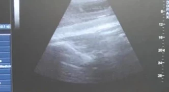 Kamea ultrasound