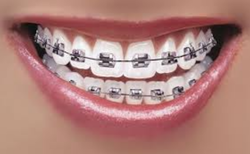 Characters who wear Braces.png