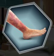 James' Broken Shin