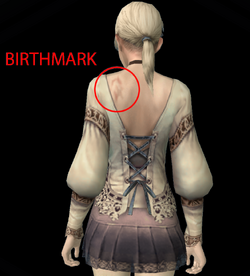 Birthmark