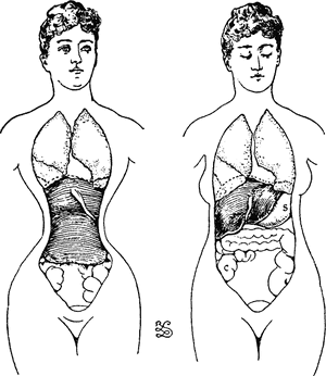Medical effects of corset wearing. 1881 illustration showing how tight-fitting  corsets compress the body's internal organs. The liver (red, centre) an  Stock Photo - Alamy