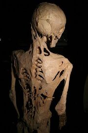 Fibrodysplasia ossificans progressiva