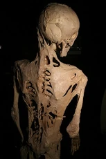 Result of Fibrodysplasia Ossificans Progressiva, a genetic condition that gradually turns bodily connective tissue into bone.