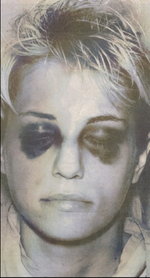 Homolka black eyes