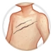 Chest Scars thumbnail.