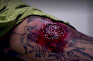 Bite wound from Ricky Simmons