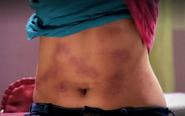 2 Olivia bruises