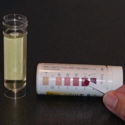 Serious ketones detected in urine with Ketostix. The color of the test pad matches 80, or Large, on the Ketostix color chart. Medical intervention is needed right away.