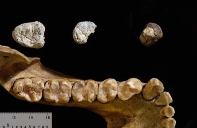 The jaw of Chororapithecus abyssinicus