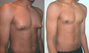 Adolescent with Gynecomastia