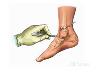 A procedure on the ankle