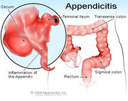 Appendicitis