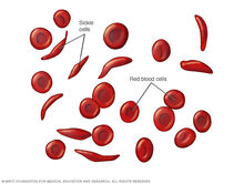SickleCellAnemia.jpg