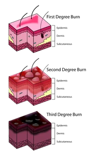 Burn Degree Diagram svg